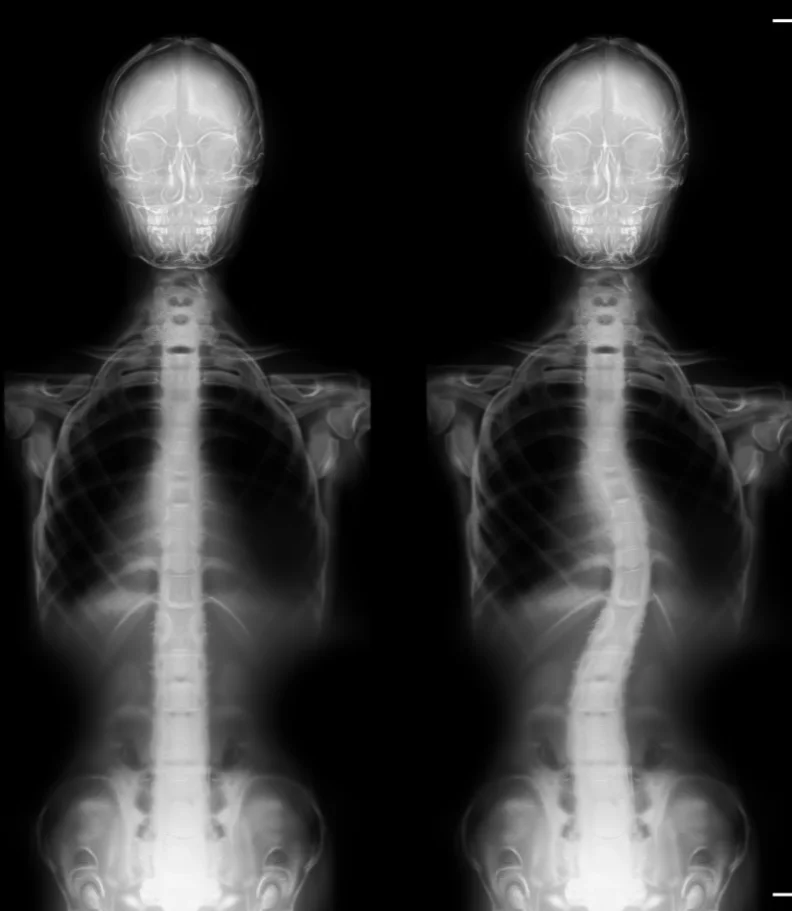 scoliosis Eldridge IA